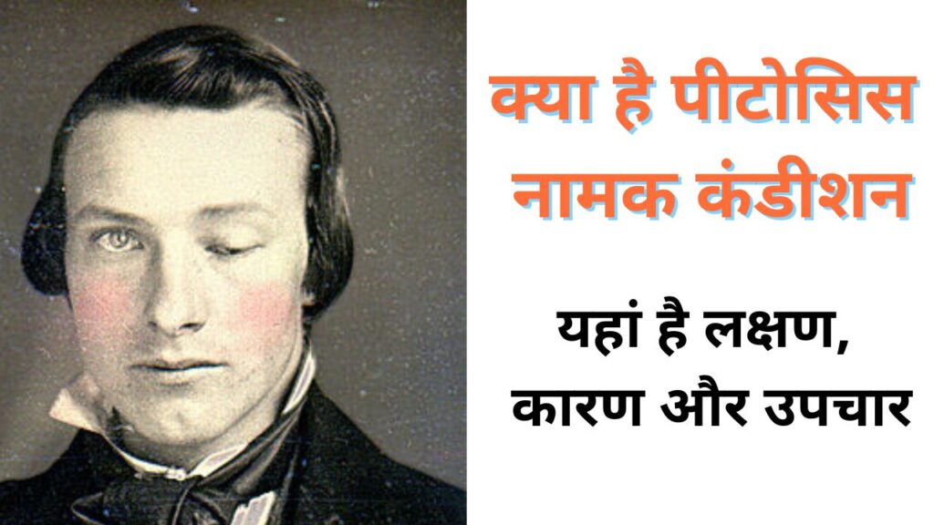 क्या है पीटोसिस नामक कंडीशन (What is ptosis condition?) पलक झपकने की स्थिति के लक्षण, कारण और उपचार